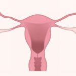 pcos.
